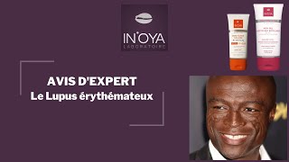 Questce que le lupus érythémateux  Types prévention et traitement sur peau noire [upl. by Navinod]