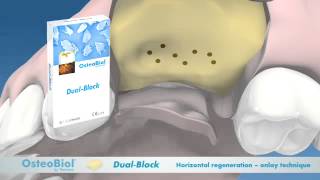 OsteoBiol® DualBlock [upl. by Nivlek]