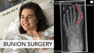 BUNION SURGERY I Would I do it again Lets talk about pain scars recovery [upl. by Nylirej]