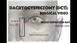 Dacryocystectomy  DCT Lacrimal Mucocele  surgical video Full HD [upl. by Loralyn]