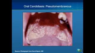 Oral Manifestations of HIV Case Studies [upl. by Keppel827]