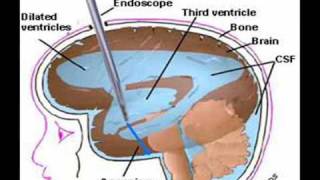 Hydrocephalus [upl. by Rossi]