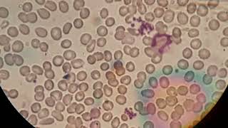 Blood film smear shows normochromic normocytic crenated red cells and aggregation of platelets [upl. by Rolph]