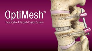 Spineology OptiLIF® with the OptiMesh® Expandable Interbody Fusion System [upl. by Adlev]