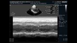 Ecocardiograma com Doppler Colorido da minha mulher [upl. by Soisinoid183]