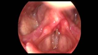 BEST ENT DOCTOR IN MUMBAIINDIA Stroboscopy 5 Videos [upl. by Gregg]