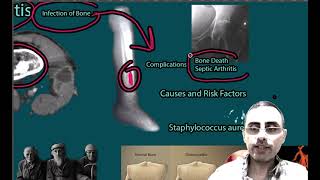 Osteomyelitis  Symptoms Causes risk factors Treatment [upl. by Neelhsa]