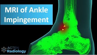 MRI of anterior ankle impingement [upl. by Yllak806]