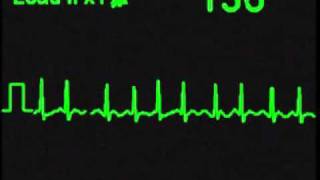 Atrial Fibrillation  AFIB  ECG Simulator  Arrhythmia Simulator [upl. by Brietta]