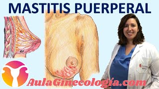 MASTITIS PUERPERAL SÍNTOMAS DIAGNÓSTICO TRATAMIENTO LACTANCIA  Ginecología y Obstetricia [upl. by Cort]