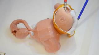 Timelapse of laparoscopic ovarian cyst removal using 3D printed models [upl. by Franci65]