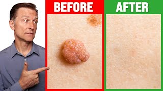 How to Rid Skin Tags and Warts Within 24 Hours  Dr Berg on Skin Tag Removal [upl. by Osman]