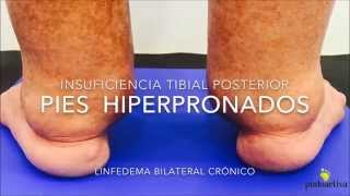 Pies Hiperpronados por insuficiencia Tibial Posterior [upl. by Ulyram]