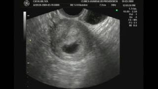 First Ultrasound 46 weeks Primer Ultrasonido 46 semanas [upl. by Avis]