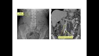 Vitamin D does not care osteoporosis  English version [upl. by Nepean]