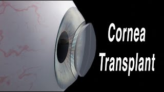 Cornea Transplant Penetrating Keratoplasty [upl. by Sama146]