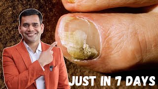 Just in 7 Days Cure Toenail Fungus At Home  Best Remedy For Toenail Fungus  Dr Vivek Joshi [upl. by Nahgen596]