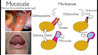 Oral Mucocele  The Most Common Mucosal lesion  Mucous Cyst Symptoms Causes amp Treatment [upl. by Yro]