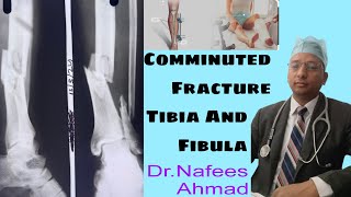 Comminuted Fracture Tibia and Fibula doctor medicalstudent ytshorts medical Lover [upl. by Eula]