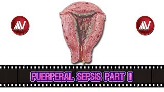 Puerperal Sepsis Part II [upl. by Yellhsa]