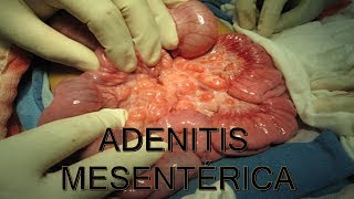 ADENITIS MESENTERICA  MEDICINA HUMANA  MediCiencia [upl. by Daye]