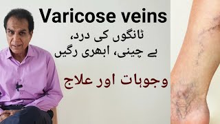 Varicose veins Causes precautions and treatment  ٹانگوں کی رگھوں کے ابھار کا علاج [upl. by Hilleary]