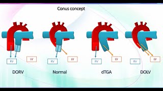 Mastering Fetal Echo in Conotruncal Anomalies [upl. by Loni]