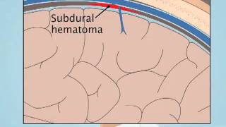 Understanding Subdural Hematoma [upl. by Yleen]