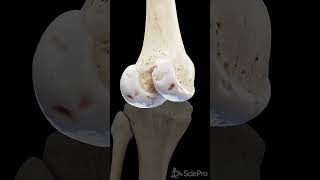 This is how Knee Arthrosis looks like anatomy meded 3danimation [upl. by Ellivnarg]