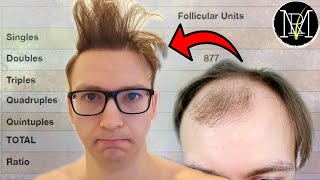 How do I style my Hair Transplant [upl. by Anoynek]