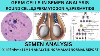 GERM CELL IN THE SEMENSPERMATOGONIASPERMATIDS IN SEMENCAUSES OF IMMATURE CELLS IN SEMEN [upl. by Bartlett]