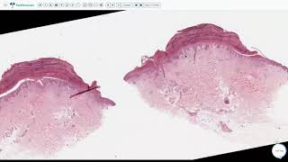 Lecture 2Psoriasiform Dermatitis [upl. by Oriaj303]