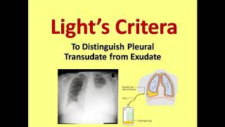 Lights Criteria for Distinguishing Transudate from Exudate [upl. by Herzberg]