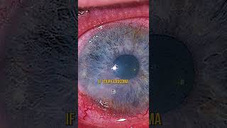 Glaucoma and the Carnivore Diet 👉 [upl. by Natanoj]