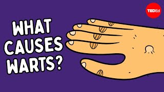 What are warts — and how do you get rid of them  Cella Wright [upl. by Namas]