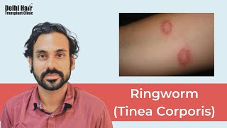 Ringworm Tinea Corporis  Causes Risk Factors Signs amp Symptoms Diagnosis and Treatment  DHTC [upl. by Florinda]