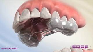 Rapid Palatal Expander RPE [upl. by Borries820]