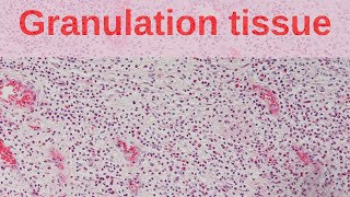 What is Granulation Tissue  Pathology mini tutorial [upl. by Phelia]