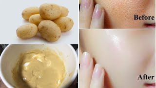 Potato Face Pack For Glowing Skin Pigmentation Acne Scars Clear Skin Beesan face pack [upl. by Nareik]