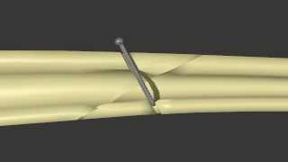 Fracture Fixation Lag Screw [upl. by Aliuqet118]