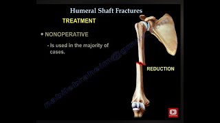 Humerus Fractures  Everything You Need To Know  Dr Nabil Ebraheim [upl. by Sucul771]