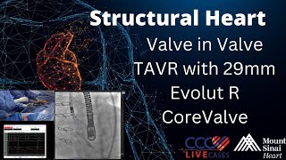 Valve in Valve TAVR with 29mm Evolut R CoreValve  January 8 2019 [upl. by Yelsa]