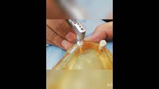 overdenture abutment preparation with amalgam plug [upl. by Clymer]