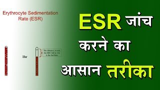 Blood Test Erythrocyte Sedimentation Rate ESR  By DPMI [upl. by Ynafetse]