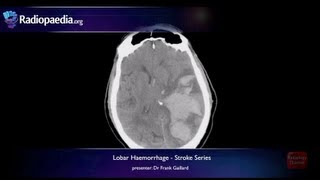 Stroke Lobar haemorrhage  radiology video tutorial MRI CT [upl. by Aivlis477]