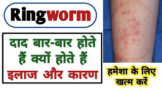 दाद खाज खुजली हमेशा के लिए खत्म करें मात्र 10 दिन में  Ringworm  Daad  Fungal infections  Tinea [upl. by Bendick]