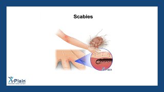 Scabies [upl. by Arlene]