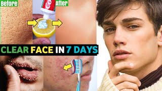 5 COMMON Skin Problems 5 Easy Solutions For HANDSOME Face  Acne Dark Skin Dark Circles [upl. by Enitram]