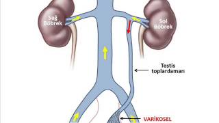 Varikosel embolizasyonu [upl. by Laddie]