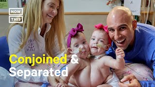 Conjoined Twins Separated After Successful Surgery [upl. by Ninos777]